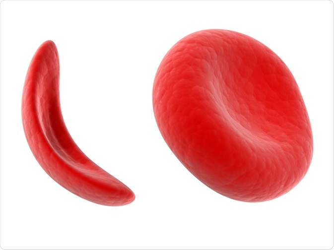 Sickle Cell Sickle Cell