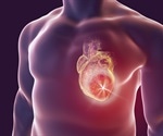 Myocarditis after SARS-CoV-2 vaccine