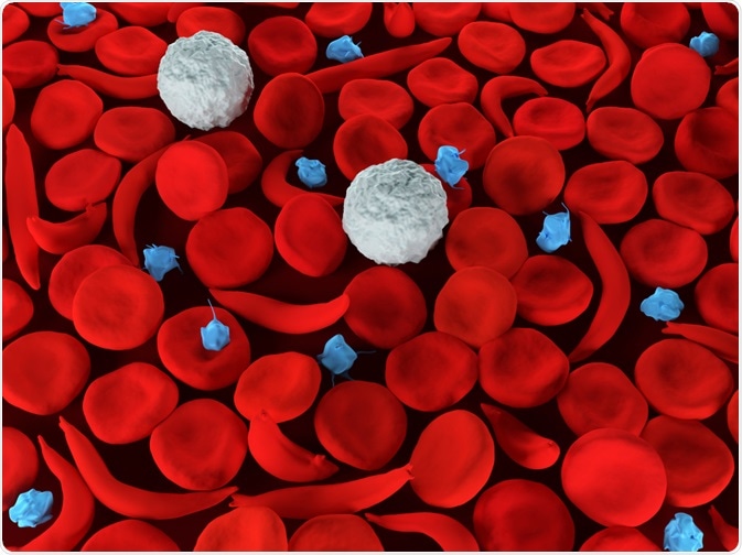 Sickle Cell Disease
