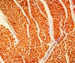 CDC reports rare cases of heart inflammation in young men after mRNA COVID-19 vaccination