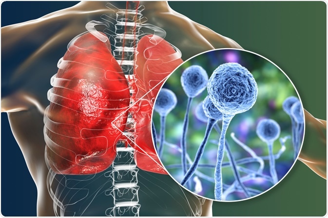 Mucormycosis Mucormycosis