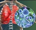 Diabetes and Mucormycosis