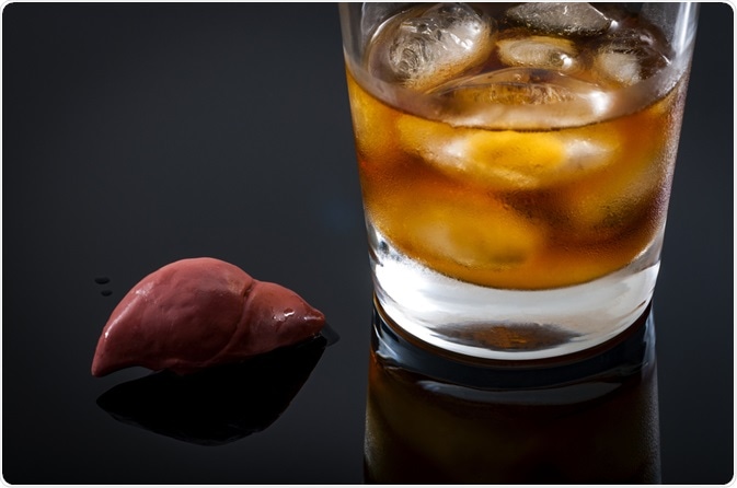 Alcoholic Hepatitis Alcoholic Hepatitis