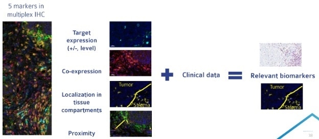 Multiplex IHC allows for analysis of a large number of parameters on a single tissue section. Compiling multiplex IHC results with clinical data can allow for the identification of a more targeted biomarker approach for late phase clinical trials. Multiplex IHC allows for analysis of a large number of parameters on a single tissue section. Compiling multiplex IHC results with clinical data can allow for the identification of a more targeted biomarker approach for late phase clinical trials.
