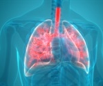 Viral vs Bacterial Pneumonia