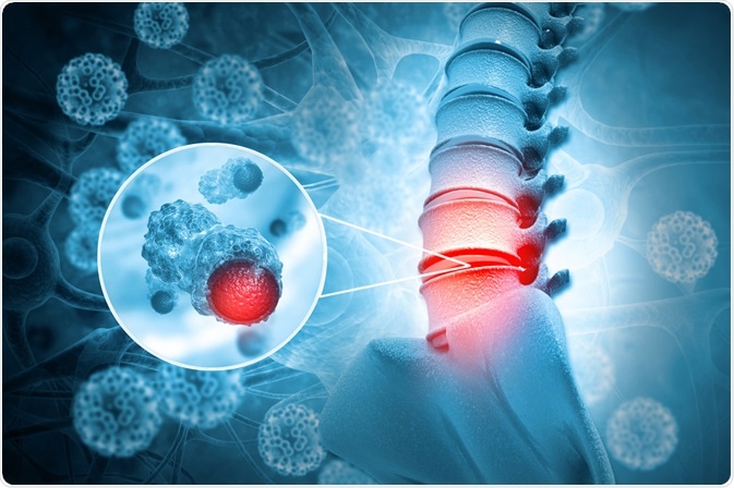 Spinal tumor Spinal tumor