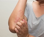 How can COVID-19 affect the skin?