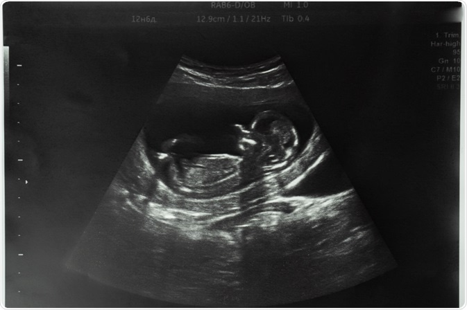 Fetus Fetus