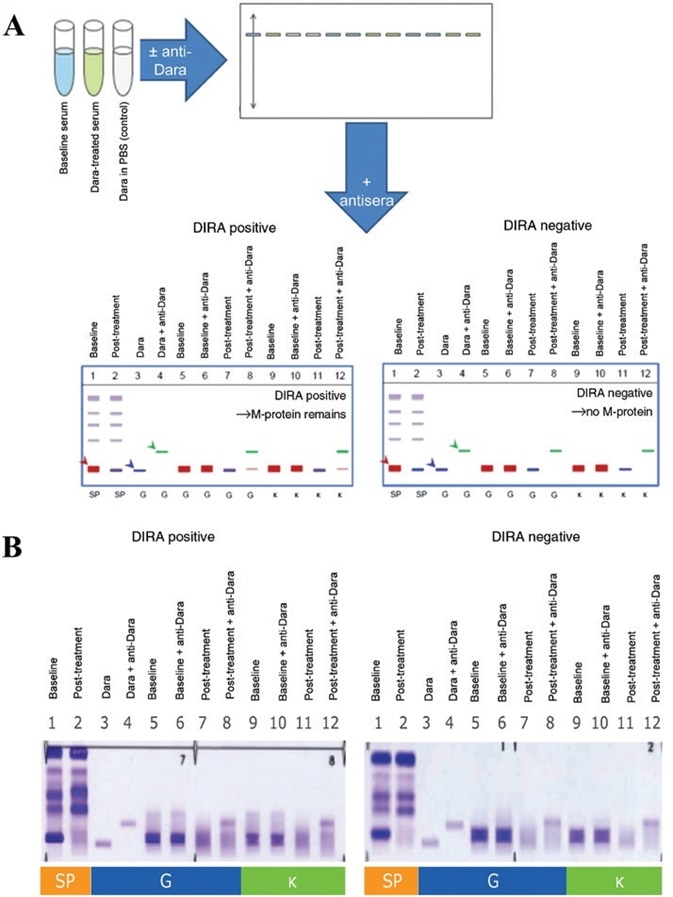 Daratumumab-specific IFE reflex assay. Daratumumab-specific IFE reflex assay.