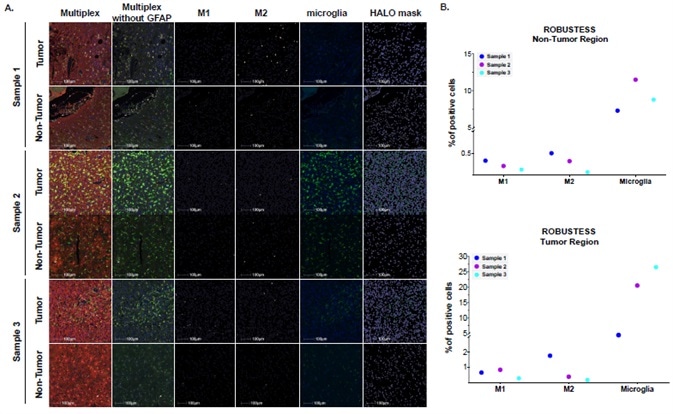 Investigating human glioblastoma tissues using a multiplex panel