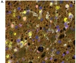 Investigating human glioblastoma tissues using a multiplex panel