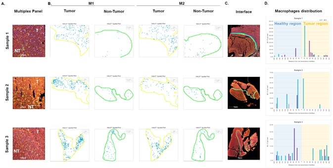 Investigating human glioblastoma tissues using a multiplex panel