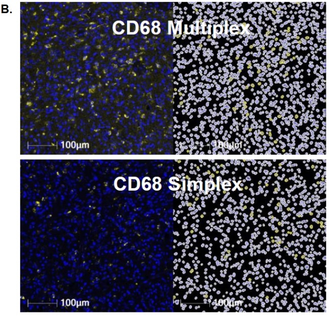 Investigating human glioblastoma tissues using a multiplex panel