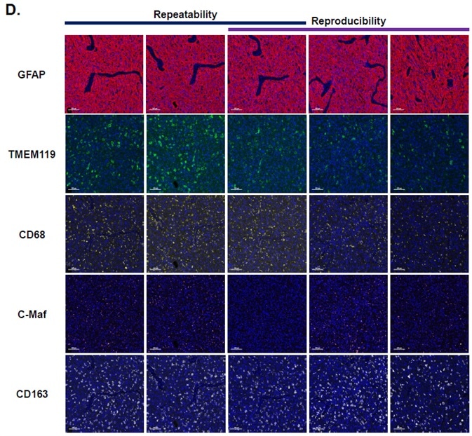 Investigating human glioblastoma tissues using a multiplex panel