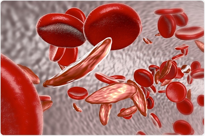 sickle cell sickle cell