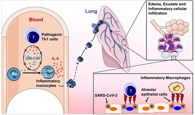 The pivotal role of IL-6 in the progression of COVID-19 patients. The pivotal role of IL-6 in the progression of COVID-19 patients.