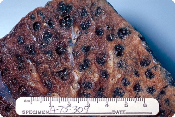 Gross pathology of lung showing centrilobular emphysema characteristic of smoking. Closeup of fixed, cut surface shows multiple cavities lined by heavy black carbon deposits. Gross pathology of lung showing centrilobular emphysema characteristic of smoking. Closeup of fixed, cut surface shows multiple cavities lined by heavy black carbon deposits.