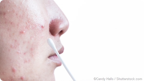 face acne