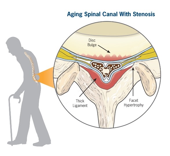AgingSpineMan