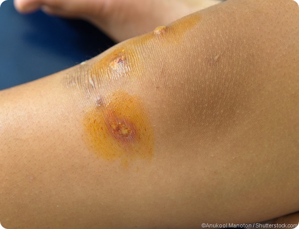 Child with impetigo