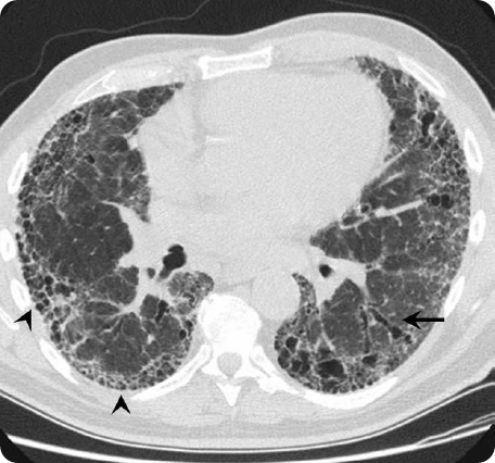 HRCT scan