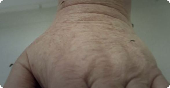 Malaria photo 8