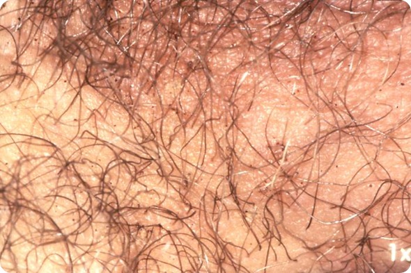 Pthirus pubis Pthirus pubis