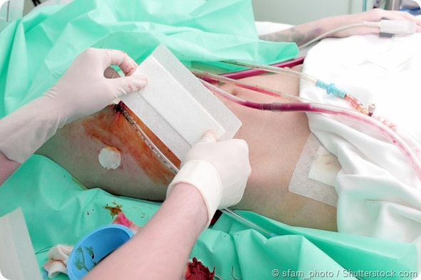 Underground kidney transplant surgery concept