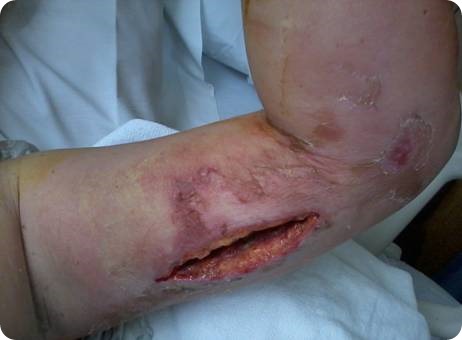 Wound