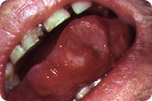 canker sores canker sores