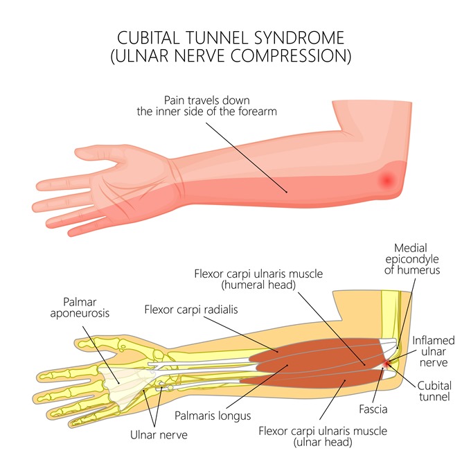 cubital tunnel syndrome cubital tunnel syndrome