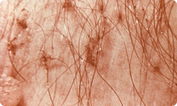 infestation of Phthirus pubis infestation of Phthirus pubis