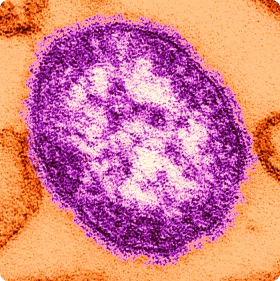 This thin-section transmission electron micrograph (TEM) revealed the ultrastructural appearance of a single virus particle, or “virion”, of measles virus. The measles virus is a paramyxovirus, of the genus Morbillivirus. It is 100-200 nm in diameter, with a core of single-stranded RNA, and is closely related to the rinderpest and canine distemper viruses. Two membrane envelope proteins are important in pathogenesis. They are the F (fusion) protein, which is responsible for fusion of virus and host cell membranes, viral penetration, and hemolysis, and the H (hemagglutinin) protein, which is responsible for adsorption of virus to cells.
