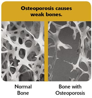 Osteoporosis Osteoporosis