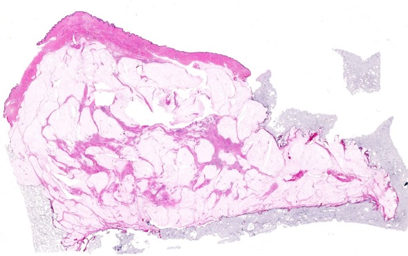 whole mount breast