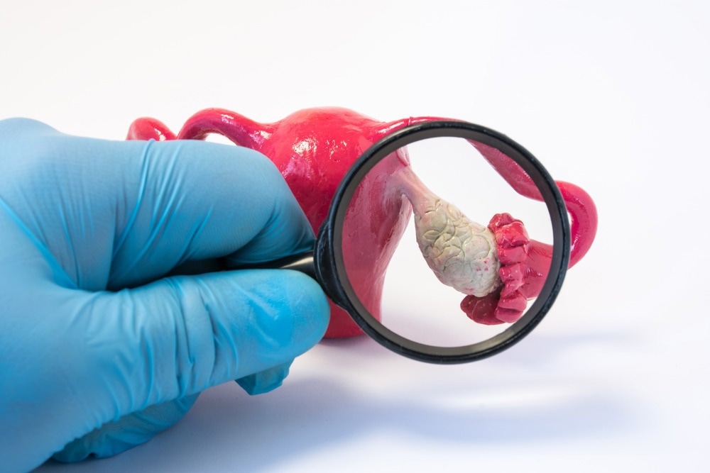 Ovarian Cyst