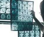 Alzheimer's Disease Symptoms