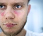 What is Lupus?