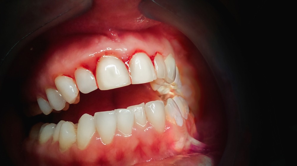 Bleeding Gums