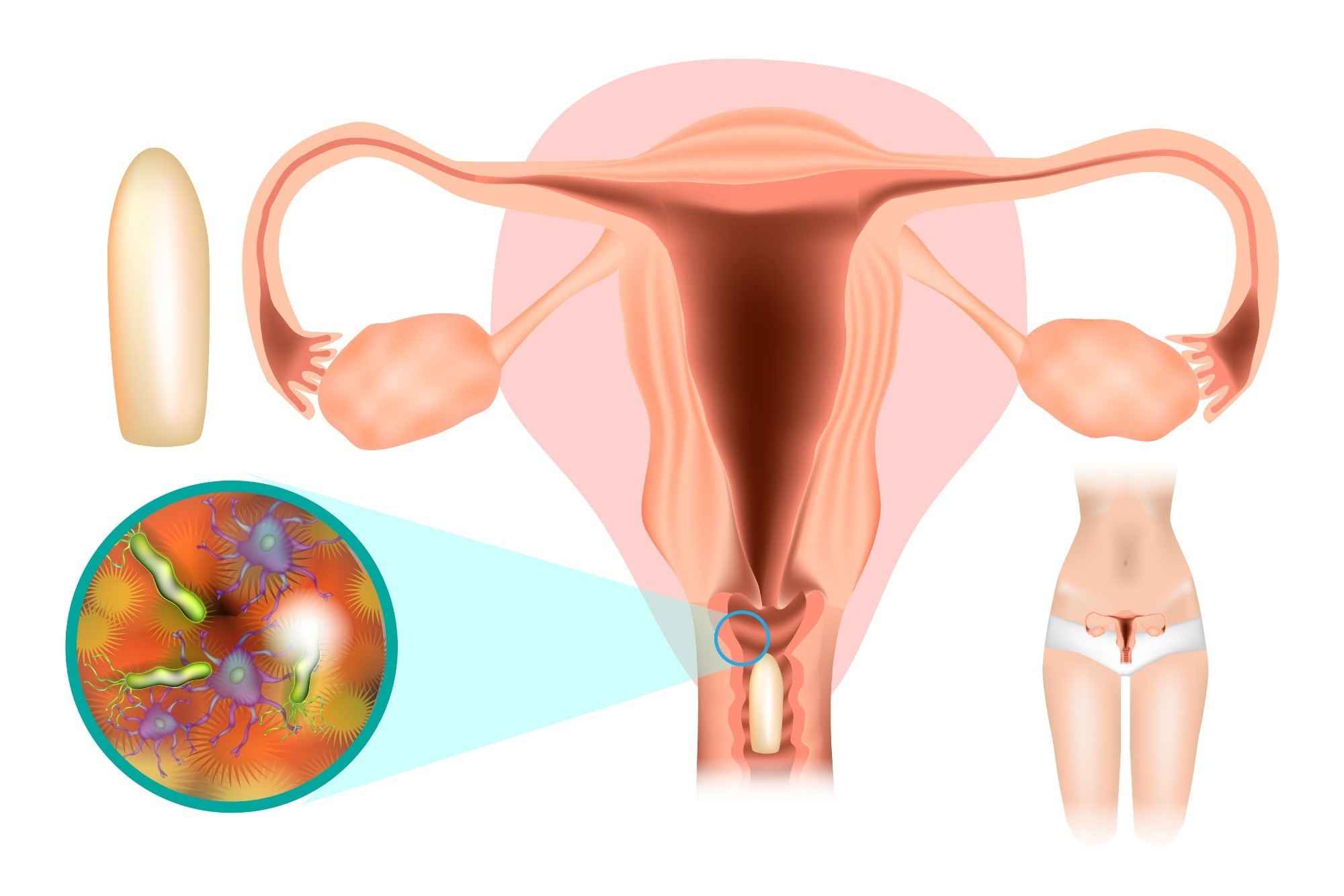 Vaginitis