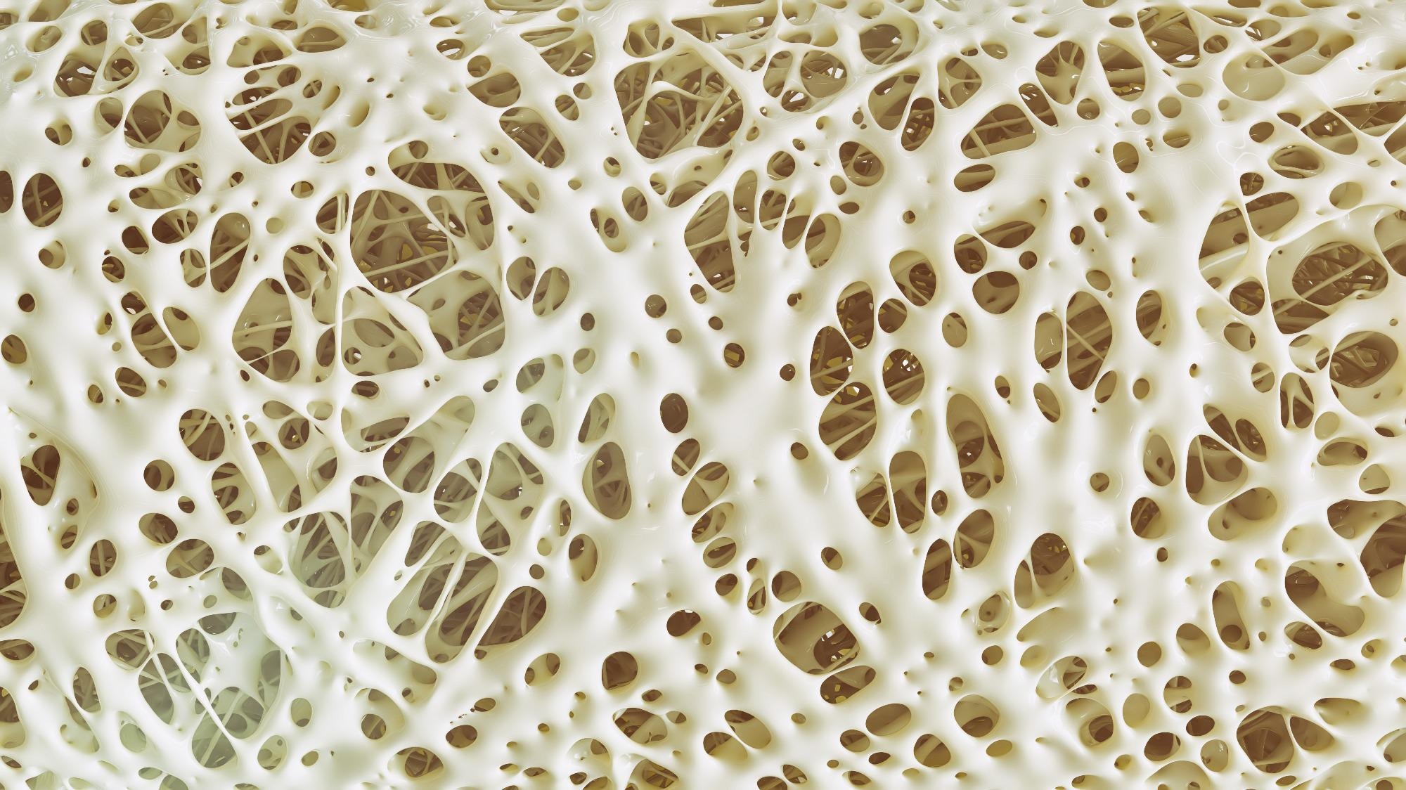 Osteoporosis