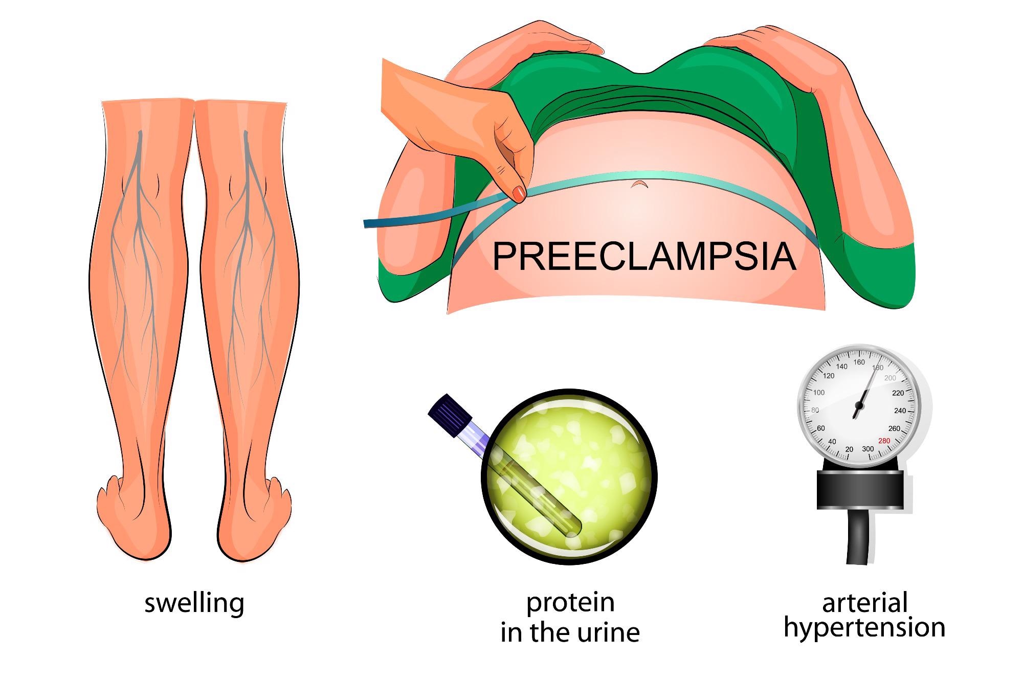 Pre-Eclampsia