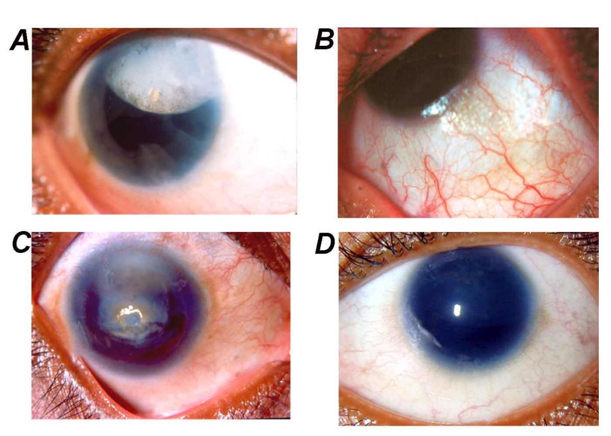 By Neethirajan G, Krishnadas SR, Vijayalakshmi P, Shashikant S, Sundaresan P. PAX6 gene variations associated with aniridia in south India. BMC Med Genet. 5, 9. 2004. PMID 15086958. DOI:10.1186/1471-2350-5-9, CC BY 2.0, https://commons.wikimedia.org/w/index.php?curid=3121372