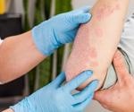 COVID-19 and Psoriasis