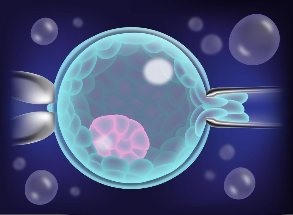 Preimplantation genetic screening.