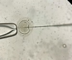 Infertility Psychological Effects