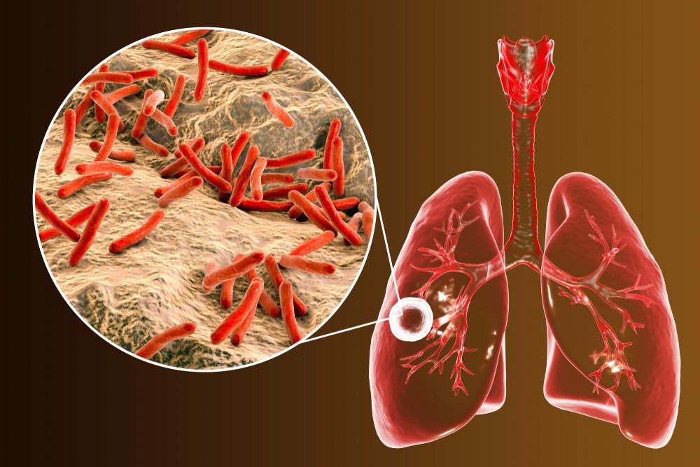 Tuberculosis