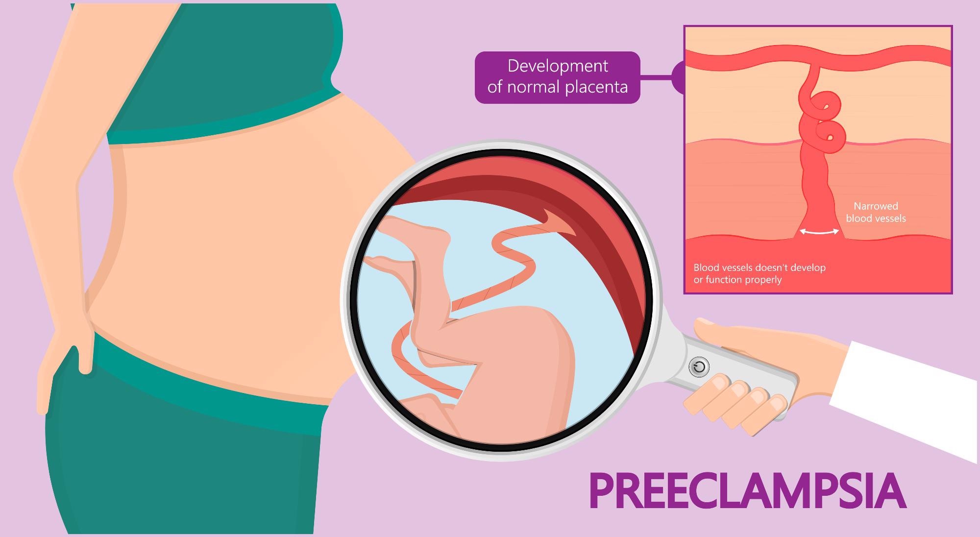Pre-eclampsia