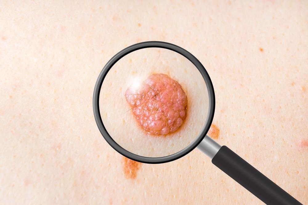 Skin Tumor