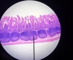 What is Jejunal Atresia?